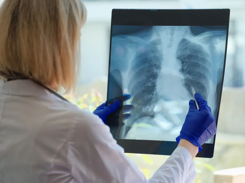 Detectar la EPOC precozmente evita el deterioro de los pulmones