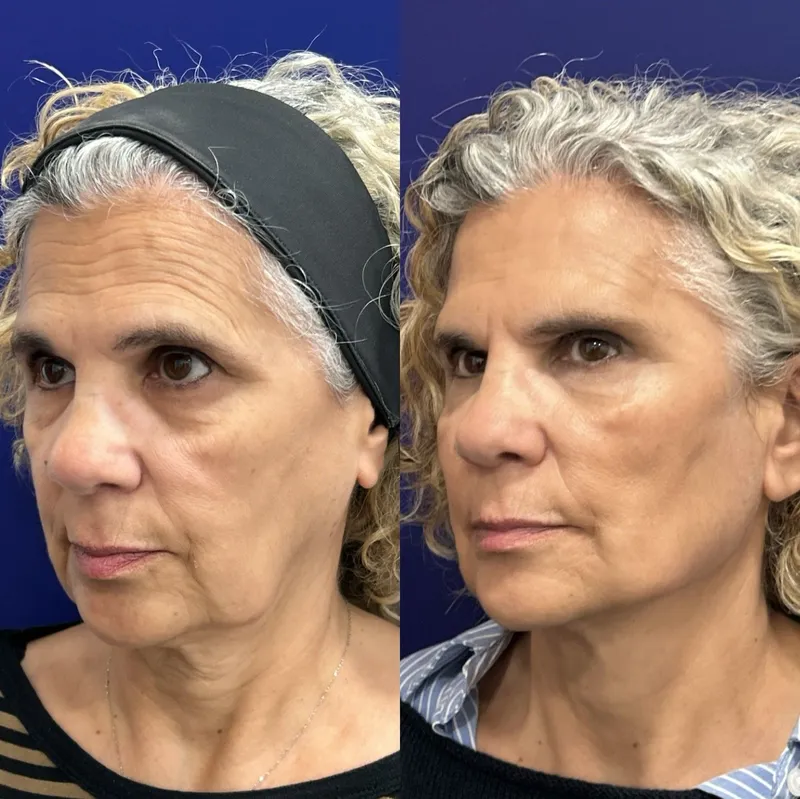 Antes y después Global Face